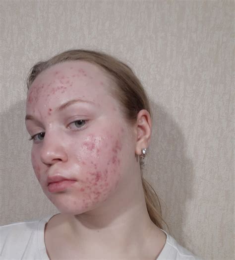 Акне 2 степень - Вопрос дерматологу - 03 Онлайн