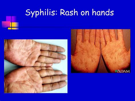 Syphilis Rash On Hands