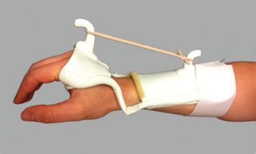 dynamic wrist extension splint  scientific diagram