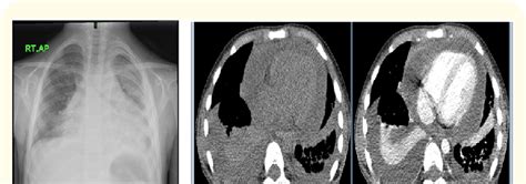 Chest X Ray And Ct Scan Pericardial And Pleural Effusions And