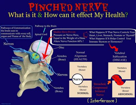 Pinched Nerves → Painless Chiropractic And Neuropathy Treatment Center