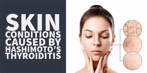 Underactive Thyroid Symptoms Eye Problems