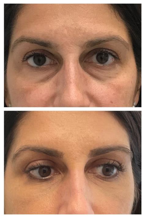 Juvederm Fillers Faq Dr Kally Papantoniou