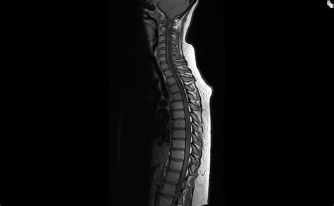 Syringomyelia MRI | Radiology article on syrinx