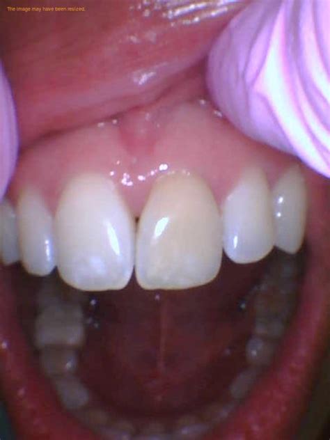 Internal Tooth Bleaching Things To Know Jackson Ave Dental