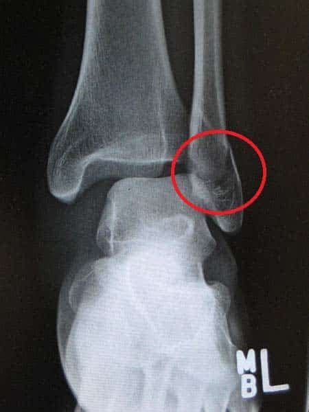 The Fibula Surfaces Articulations Fractures Teachmeanatomy