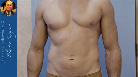 Removing More Gynecomastia Gland After First Surgery Long Island New