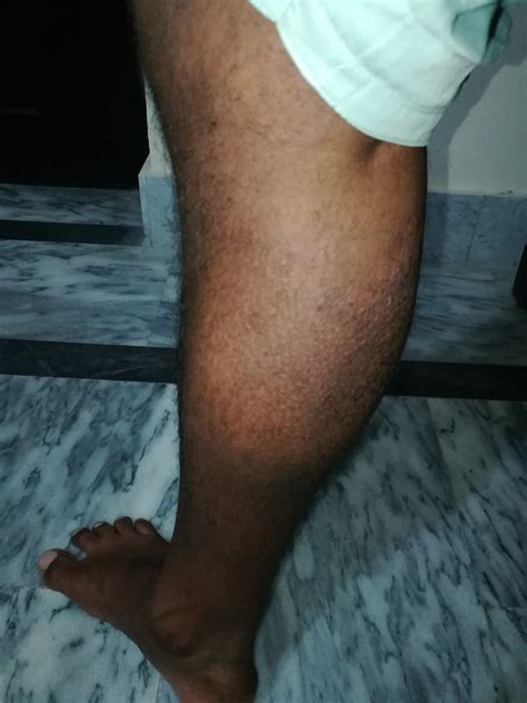 Ask a Dermatologist Online for Severe Itching On Legs