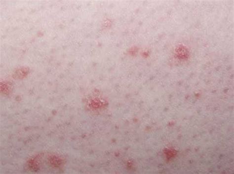 Псориаз начальная стадия – лечение, симптомы и фото