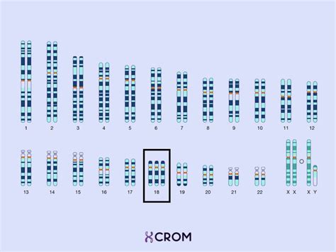 Sindrome De Edwards Adulto - Ficha técnica: Síndrome de Edwards – CROM – Instituto de Citogenética ...