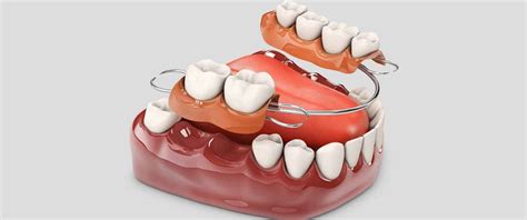 Protez Diş Nedir Kullanımı Ve Tedavisi Nefes Diş Polikliniği