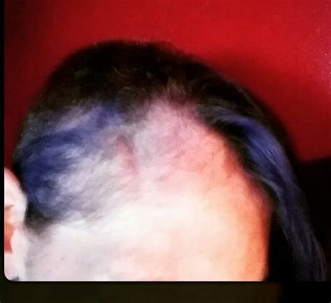 Grade 4 Glioblastoma Multiforme Rcancer