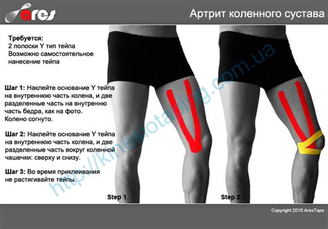 Тейп при артрозе коленного сустава