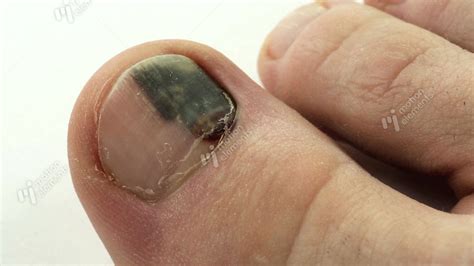 Subungual Hematoma Bruise Under The Nail Of Big Toe Stock Video