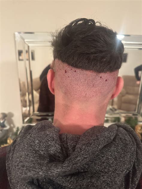 1000 grafts with Dr Mittal : r/HairTransplants