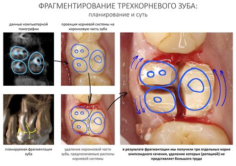 Простое удаление зуба за 10 шагов. — IMPLANT-IN.COM — дентальная ...