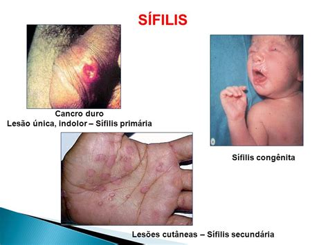 Sífilis Dst Fotos Femininas