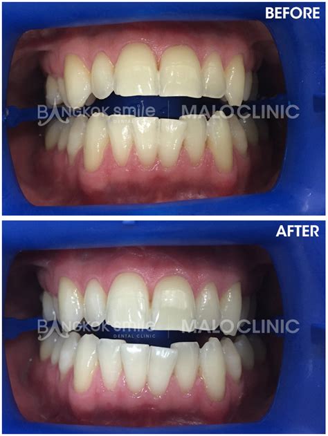 Laser Teeth Lightening Vs Specialist Bleaching Trays