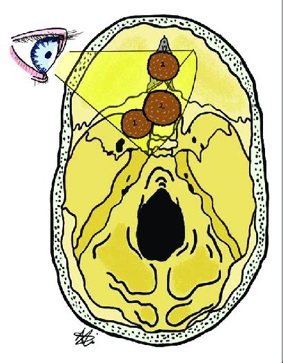 We Can Approach Various Targets In Supraorbital Craniotomy With The