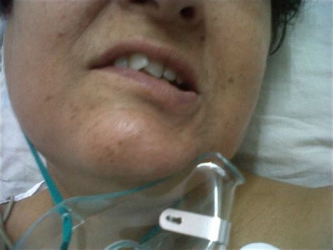 partial facial nerve paralysis  laparoscopic surgery  general