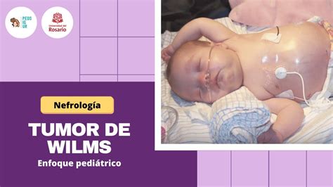 Tumor De Wilms Pedsigur Módulo De Endocrinología Youtube