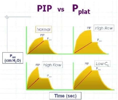 Inspiratory Plateau Pressure Ventilation