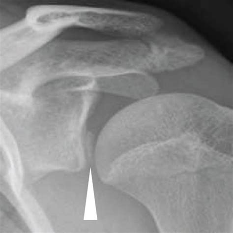 Anteroposterior Plain Film Radiographs Of The Patients Left Shoulder