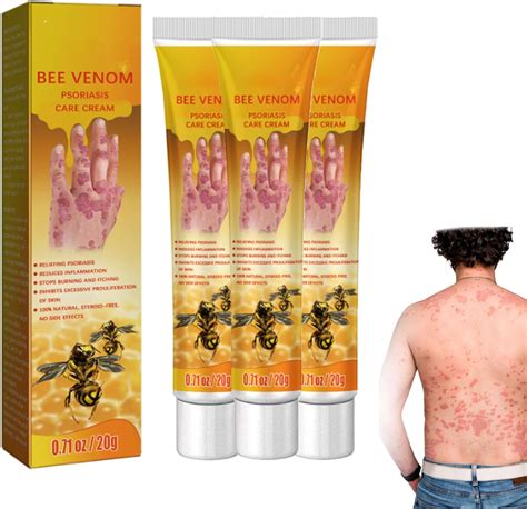 Youth Bee Venom Psoriasis Treatment Cream Youth Bee Venom Psoriasis