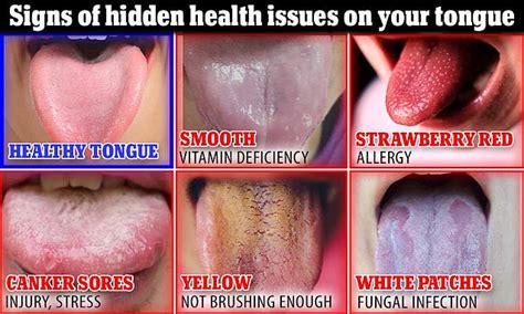 What Does Your Tongue Say About Your Health White Patches A Sign You Re Fighting An Infection