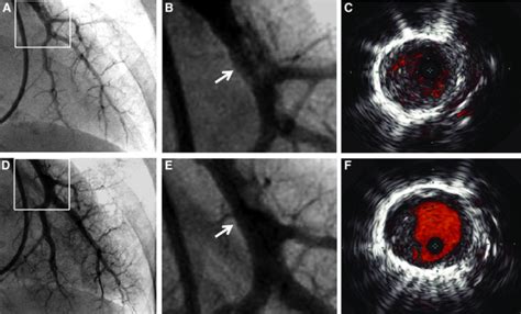 IVUS In Angioplasty Dr Atul Kasliwal S Blog Cardiology Heart Doctor