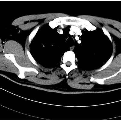 Preoperative Chest Computed Tomography Of The Patient Showing Excellent