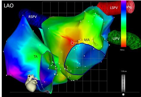 Atrial Tachycardia: Diagnosis and Treatment - The Cardiology Advisor