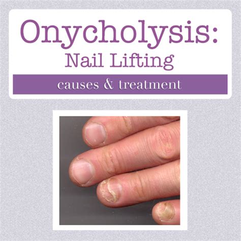 onycholysis toenail - pictures, photos