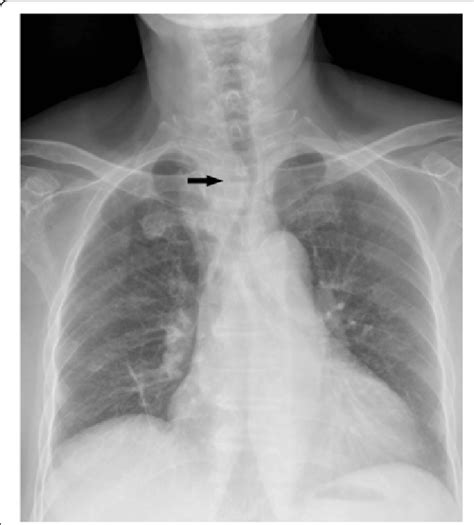 Chest radiograph: the trachea was shifted to the left, and there was ...