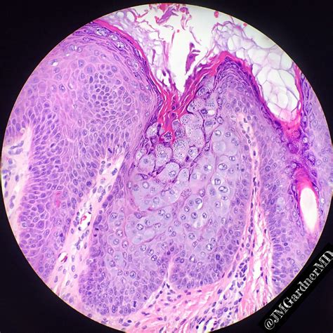 Verruca Plantaris Pathology Outlines
