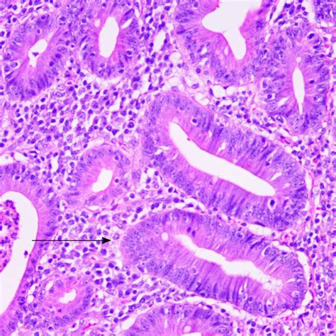 postoperative routine pathology revealed tubular villous adenoma