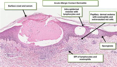 Dermatopathology Made Simple - Inflammatory: Vesicles or Blisters