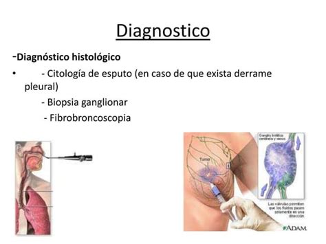 S Ndrome Vena Cava Superior Ppt