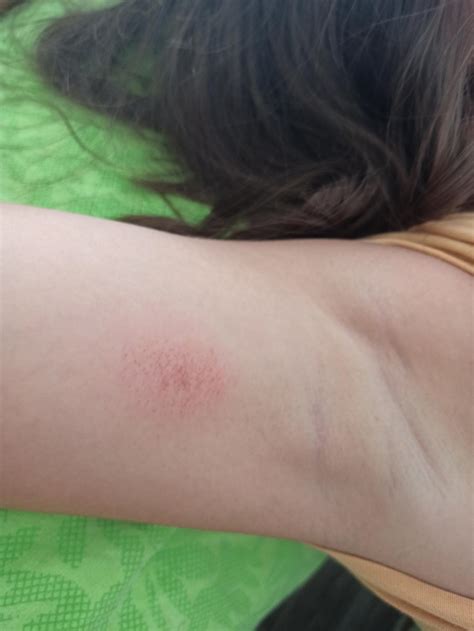 Penti Bikini Tahriş Yapıyor Şikayetvar