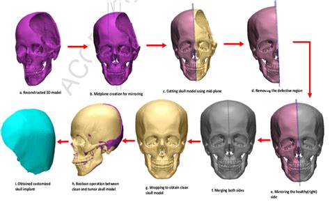 Steps Involved In The Cranial Reconstruction Implant Design Using