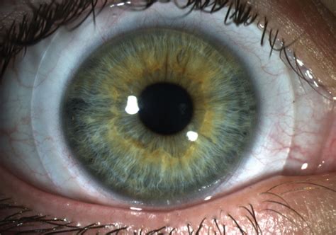 New Tools To Tame Keratoconus