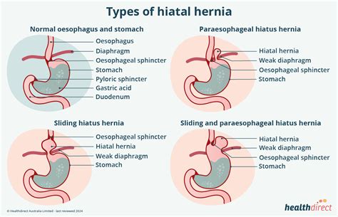 Hernias Types Causes And Whos At Risk Healthdirect