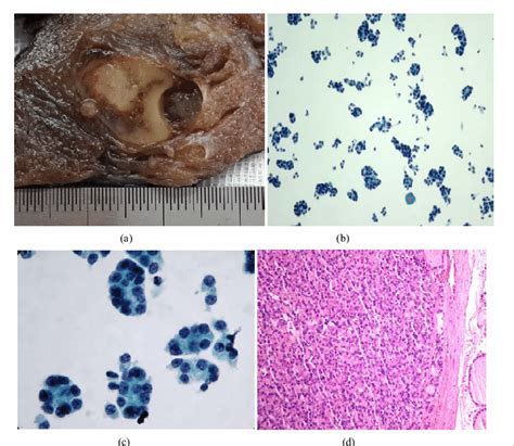 Follicular Adenoma A Macroscopically Encapsulated And Cystic Light