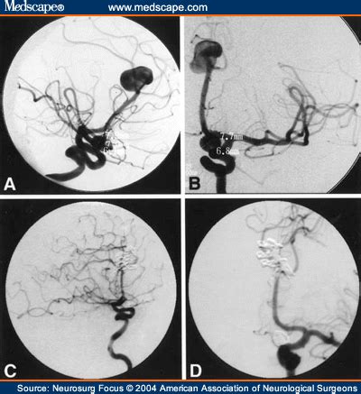 Nonsaccular Aneurysms Of The Azygos Anterior Cerebral Artery