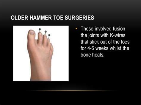 Hammer Toe Surgery – Modern Day Toe Operation