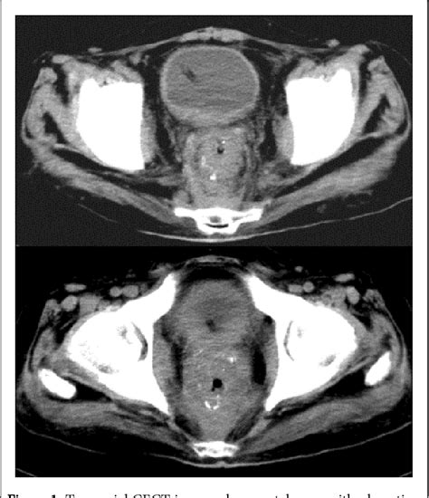 Figure 1 From Rectal Carcinoma With Osteosclerotic Metastases A Rare