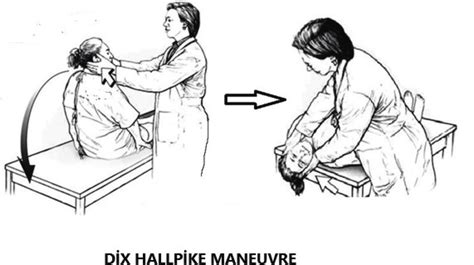 Dix Hallpike Maneuver Nystagmus In Addition To Severe Vertigo