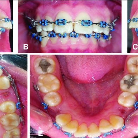 Intraoral Photographs Showing Fixed Orthodontic Appliance Used In The Download Scientific