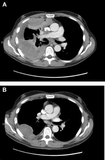 Hepatoid Adenocarcinoma Of The Lung Responsive To Frontline Combination