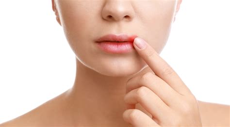 Cold Sores Heres How To Deal With Them Healthkart